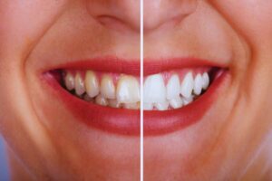 denti doppio colore